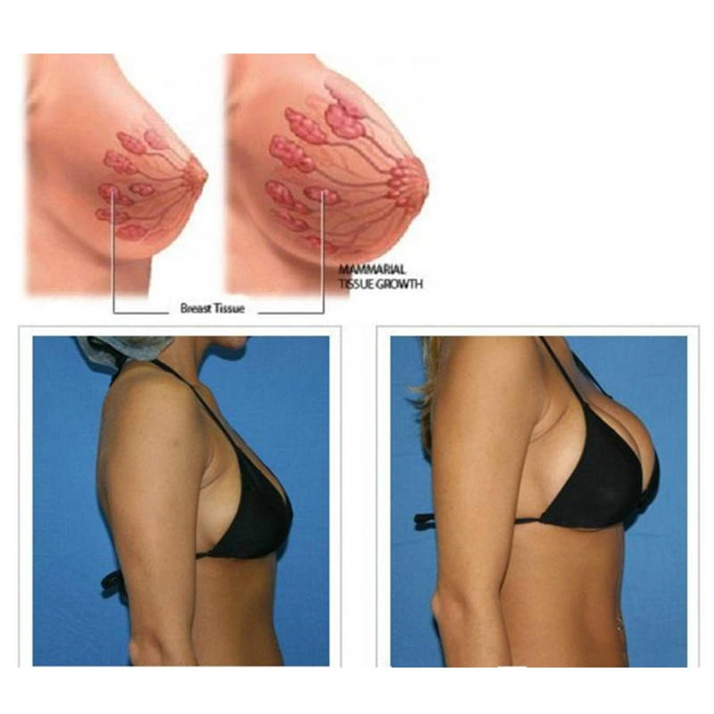 Breast Lift treatment at Vina Beauty Spa