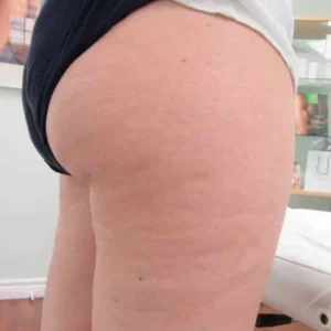 Cellulite Treatment at Vina Beauty Spa