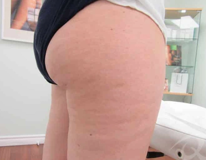 Cellulite Treatment at Vina Beauty Spa
