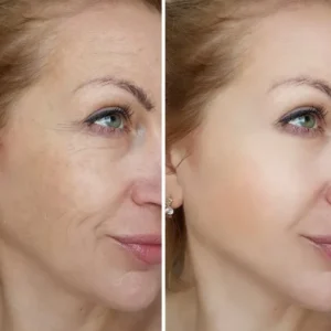 Laser Rejuvenation treatment at Vina Beauty Spa
