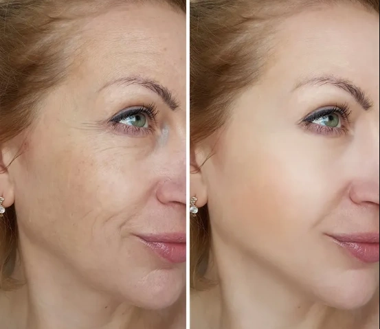 Laser Rejuvenation treatment at Vina Beauty Spa