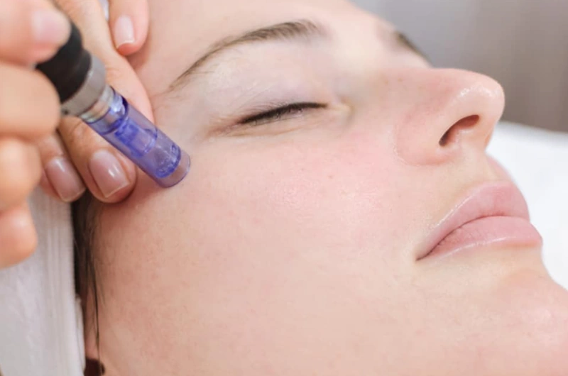 Micro Needling treatment at Vina Beauty Spa