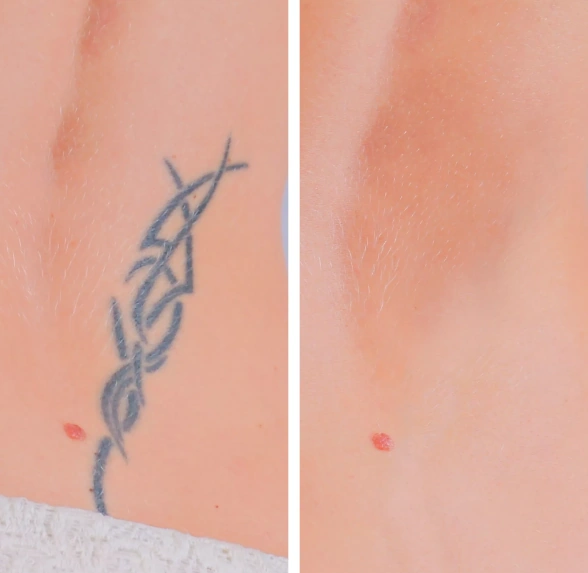 Tattoo Removal treatment at Vina Beauty Spa